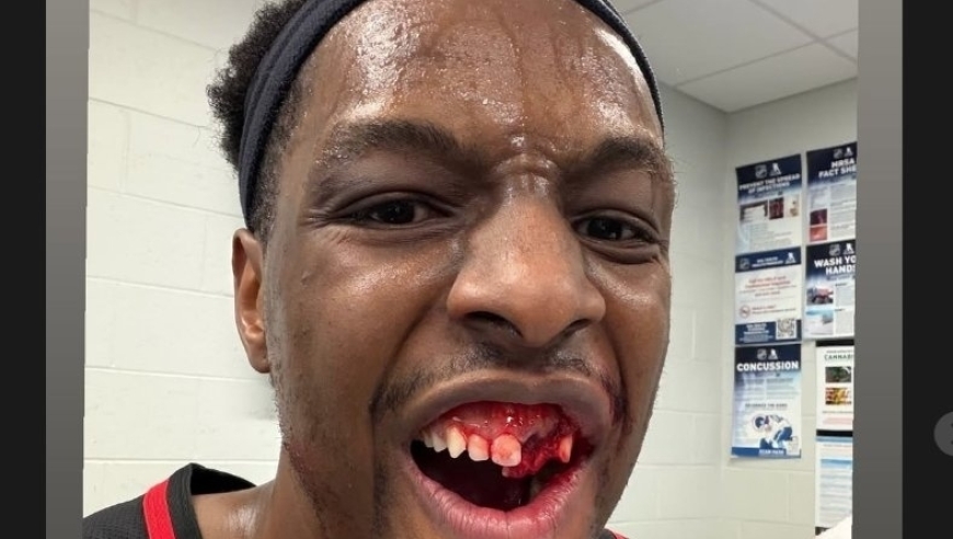 硬汉！奥孔古晒出两颗牙齿被打掉流血照 杰伦布朗道歉称肘击非故意