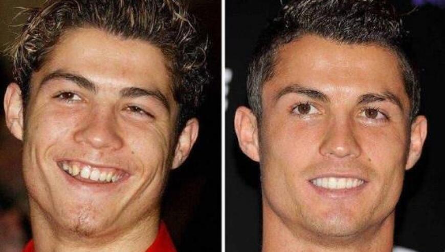 40岁C罗被爆料多次整容，整牙、隆鼻、植发，打肉毒杆菌除皱